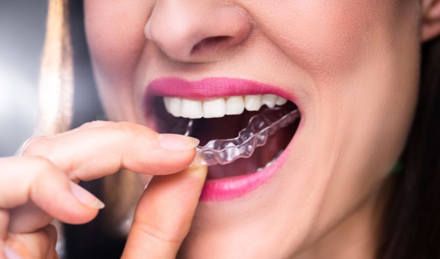 3 Quick Top Tips For Taking Care Of Your Invisalign Aligners