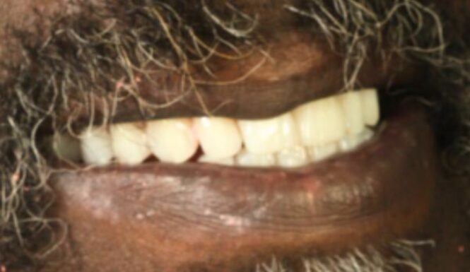 After - Alexandra Dental