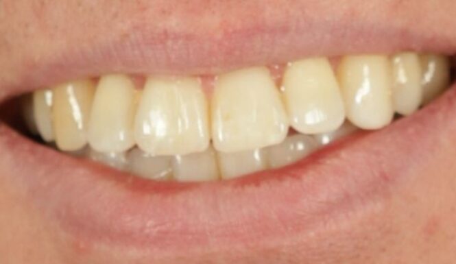 After - Alexandra Dental