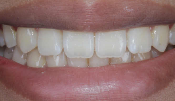 Before close up mouth