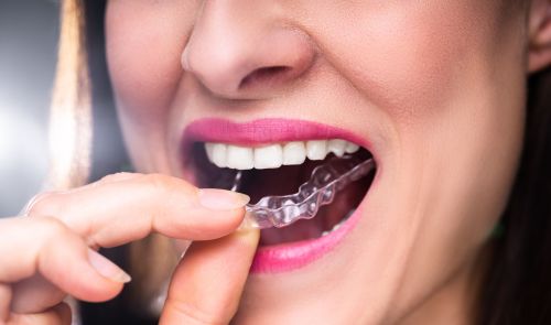 Invisalign Aligners