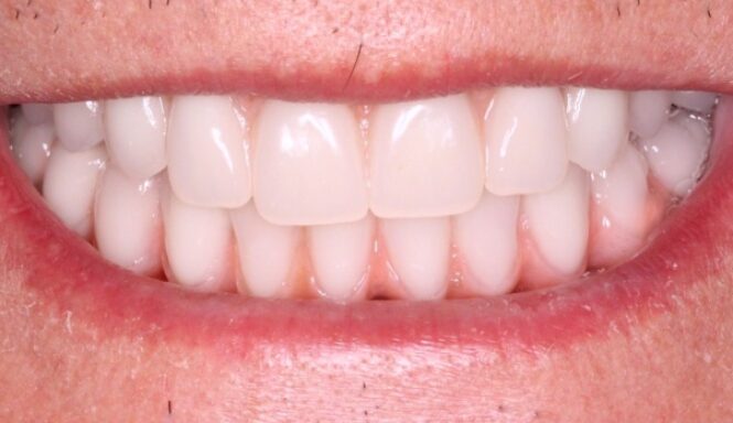 Case 1 After.pg