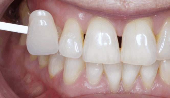 After - Alexandra Dental
