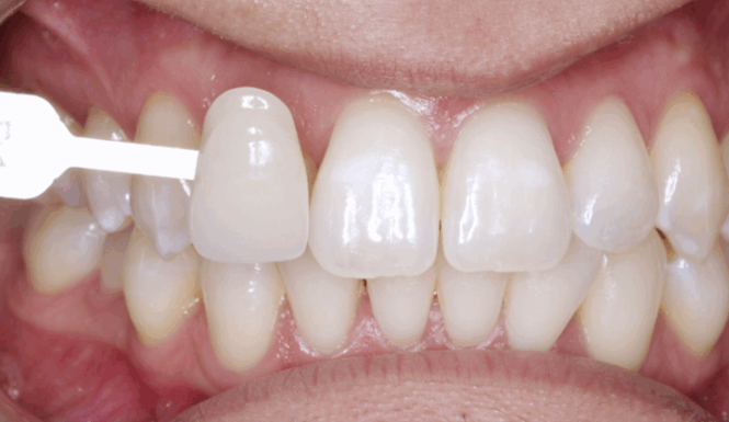After - Alexandra Dental