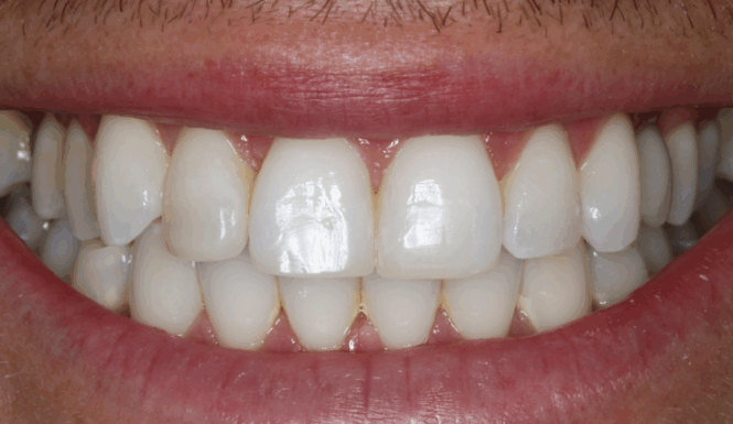 After - Alexandra Dental