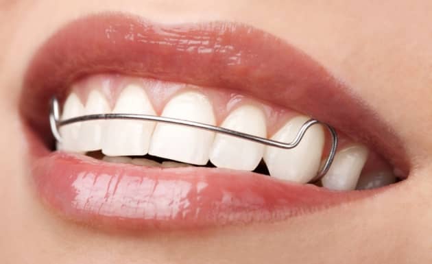 Inman Aligner